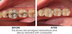 composite fillings