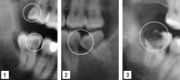 tooth decay