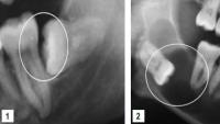 impacted wisdom tooth