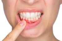 Gingivitis Fotor22