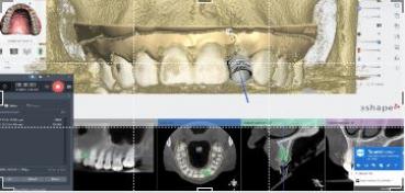 Implant1