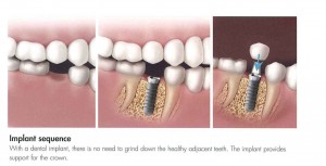 bridge-vs-crown4